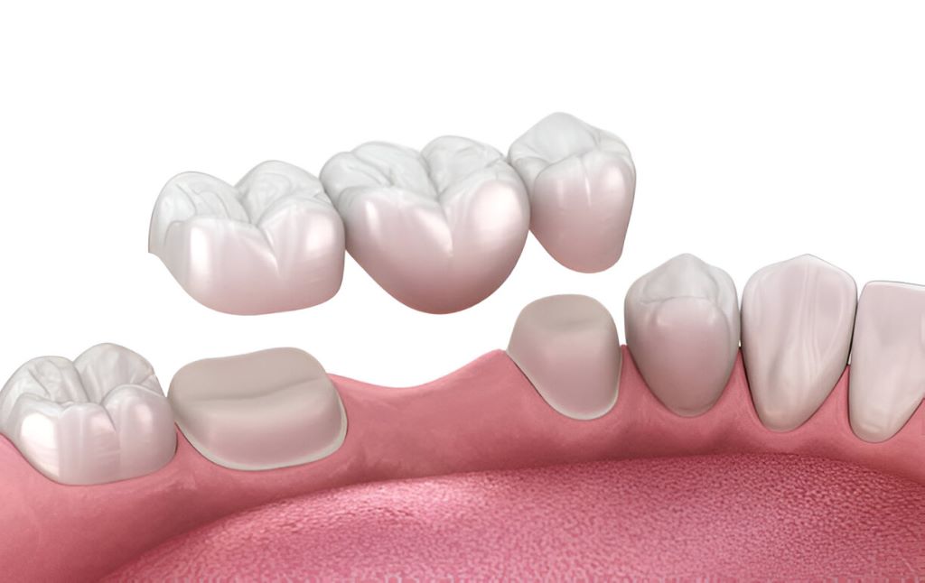 dental bridges toledo