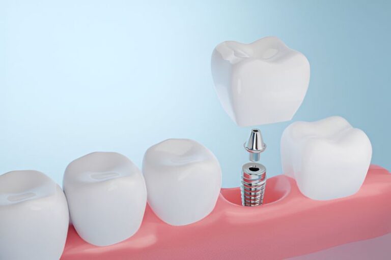 dental implants toledo