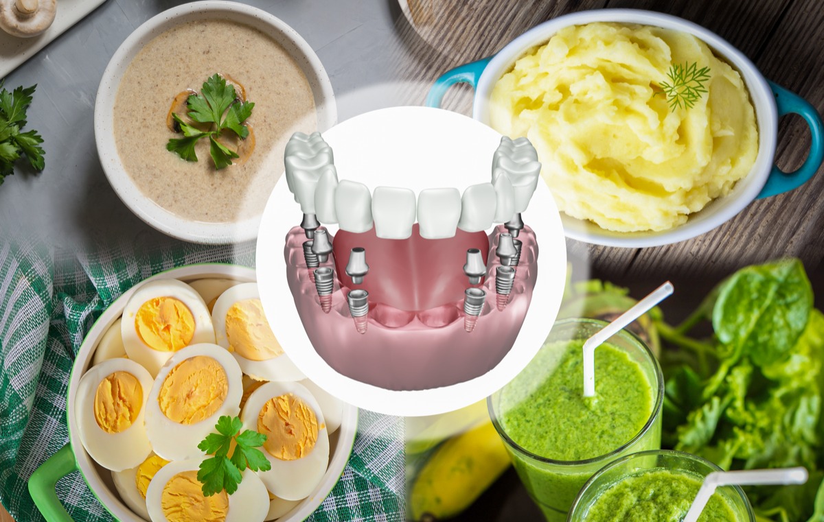 dental implant diet