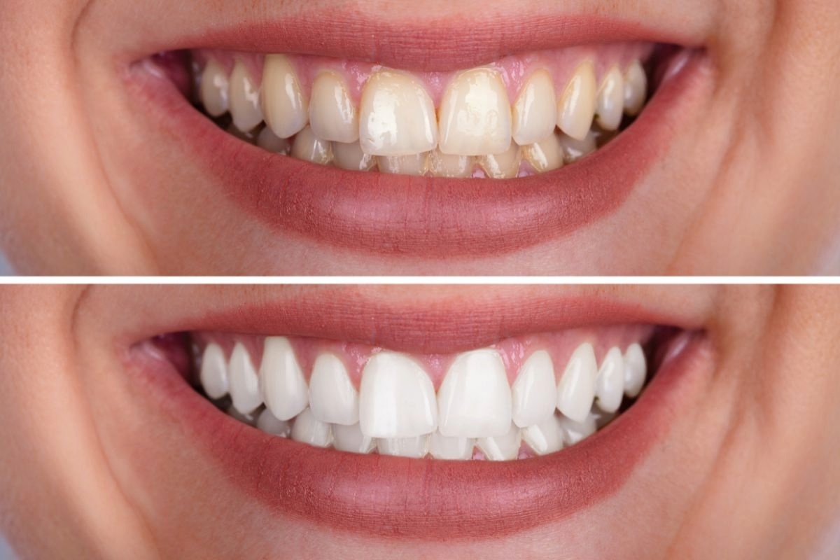 is teeth whitening safe, and can It damage my enamel