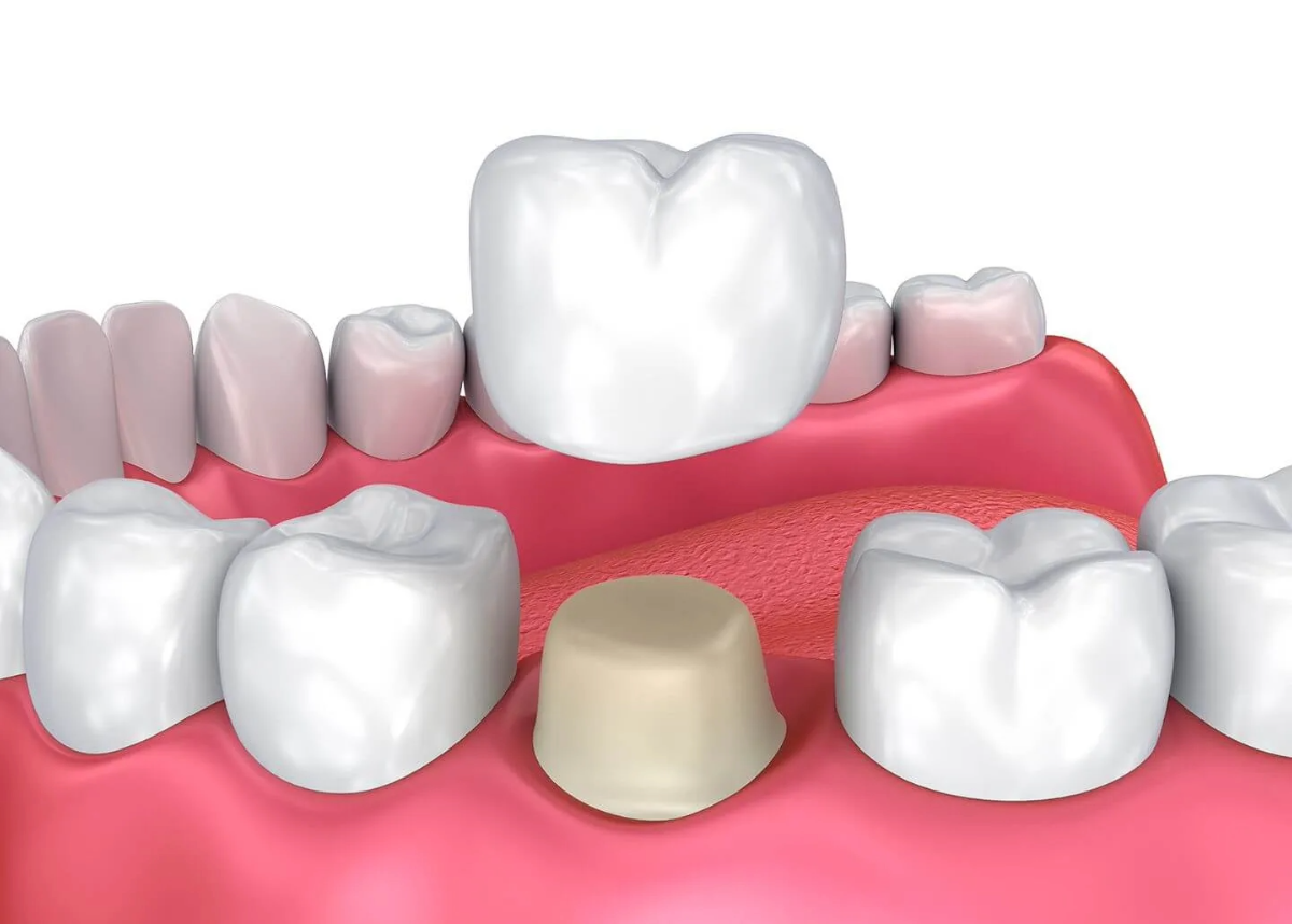 what is a dental crown