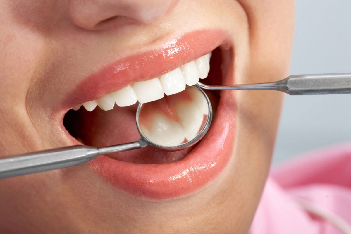 can i replace old silver fillings with white ones