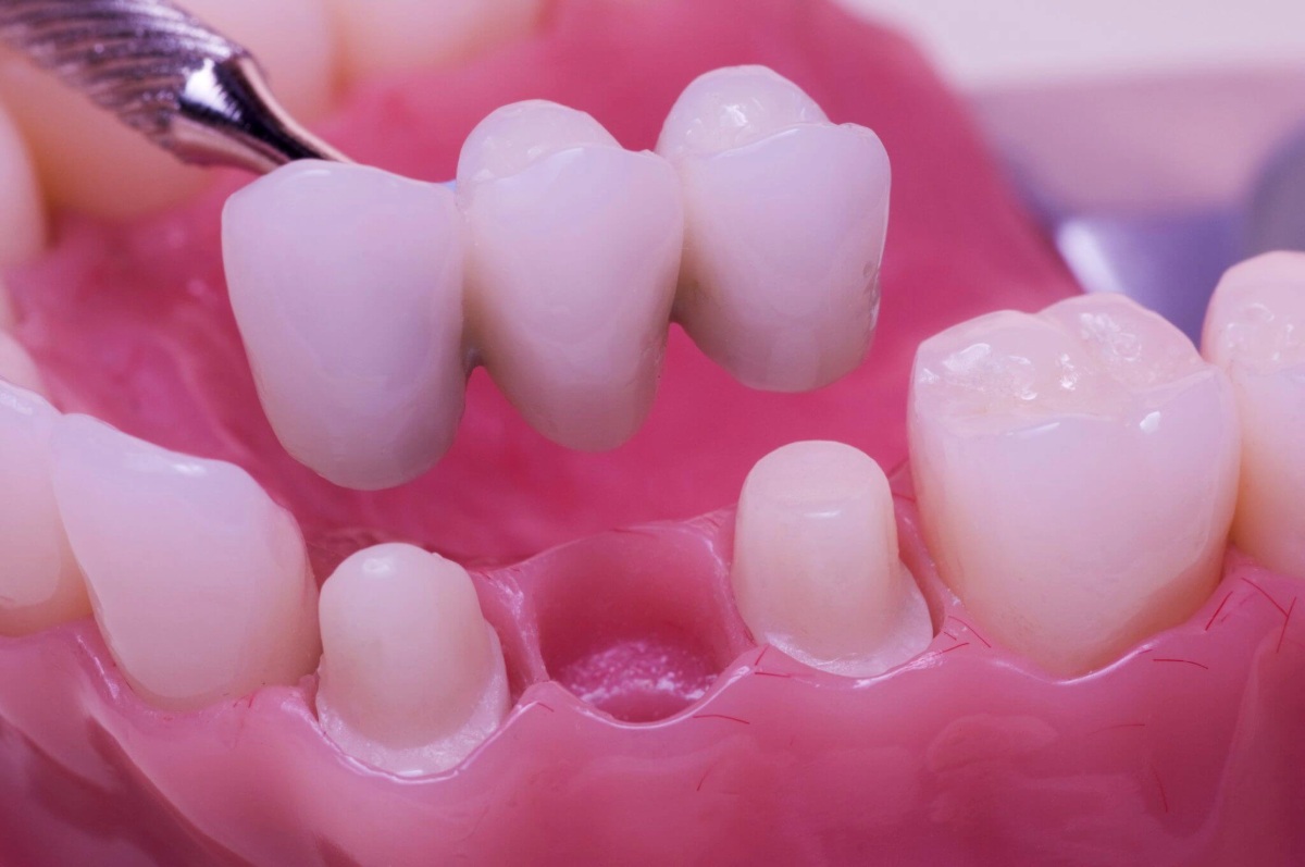 which option is better dental bridge or implants