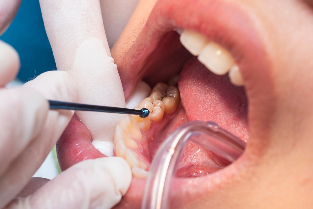 composite fillings in toledo