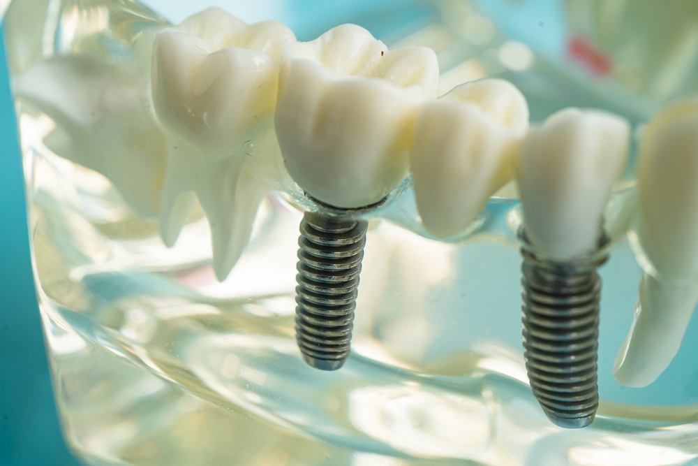 dental implants and its cost